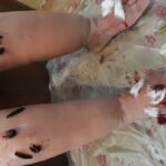 حجامت و زالو درمانی