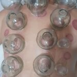 حجامت و زالو درمانی