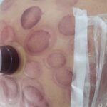 حجامت و زالو درمانی