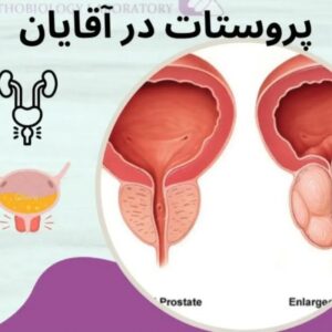 بهبود التهاب پروستات