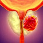 بهبود التهاب پروستات